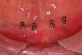 義歯の維持装置ためのインプラントを4本埋入した状態
