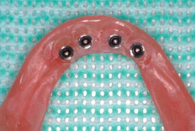 義歯の維持装置